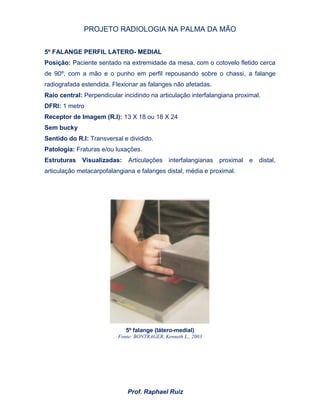 PROJETO RADIOLOGIA NA PALMA DA MÃO
Prof. Raphael Ruiz
5º FALANGE PERFIL LATERO- MEDIAL
Posição: Paciente sentado na extremidade da mesa, com o cotovelo fletido cerca
de 90º, com a mão e o punho em perfil repousando sobre o chassi, a falange
radiografada estendida. Flexionar as falanges não afetadas.
Raio central: Perpendicular incidindo na articulação interfalangiana proximal.
DFRI: 1 metro
Receptor de Imagem (R.I): 13 X 18 ou 18 X 24
Sem bucky
Sentido do R.I: Transversal e dividido.
Patologia: Fraturas e/ou luxações.
Estruturas Visualizadas: Articulações interfalangianas proximal e distal,
articulação metacarpofalangiana e falanges distal, média e proximal.
5º falange (látero-medial)
Fonte: BONTRAGER, Kenneth L., 2003
 
