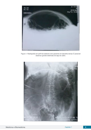 Medicina e Biomedicina Capítulo 1 4
Figura 1: Radiografia em perfil de abdome com paciente em decúbito dorsal. É possível
observar grande distensão de alça do cólon.
 