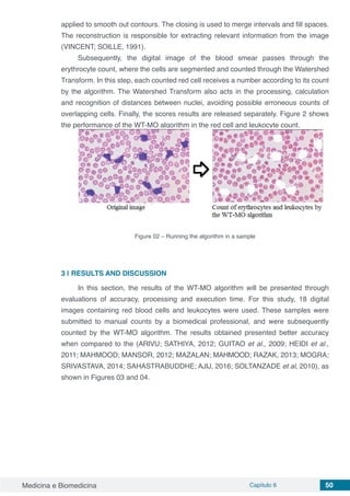 Medicina e Biomedicina Capítulo 6 50
applied to smooth out contours. The closing is used to merge intervals and fill spaces.
The reconstruction is responsible for extracting relevant information from the image
(VINCENT; SOILLE, 1991).
Subsequently, the digital image of the blood smear passes through the
erythrocyte count, where the cells are segmented and counted through the Watershed
Transform. In this step, each counted red cell receives a number according to its count
by the algorithm. The Watershed Transform also acts in the processing, calculation
and recognition of distances between nuclei, avoiding possible erroneous counts of
overlapping cells. Finally, the scores results are released separately. Figure 2 shows
the performance of the WT-MO algorithm in the red cell and leukocyte count.
Figure 02 – Running the algorithm in a sample
3 | 	RESULTS AND DISCUSSION
In this section, the results of the WT-MO algorithm will be presented through
evaluations of accuracy, processing and execution time. For this study, 18 digital
images containing red blood cells and leukocytes were used. These samples were
submitted to manual counts by a biomedical professional, and were subsequently
counted by the WT-MO algorithm. The results obtained presented better accuracy
when compared to the (ARIVU; SATHIYA, 2012; GUITAO et al., 2009; HEIDI et al.,
2011; MAHMOOD; MANSOR, 2012; MAZALAN; MAHMOOD; RAZAK, 2013; MOGRA;
SRIVASTAVA, 2014; SAHASTRABUDDHE; AJIJ, 2016; SOLTANZADE et al, 2010), as
shown in Figures 03 and 04.
 