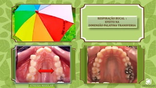 ATRESIA MAXILAR
RESPIRAÇÃO BUCAL :
EFEITO NA
DIMENSÃO PALATINA TRANSVERSA
 