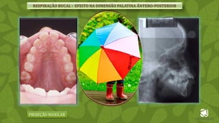 PROJEÇÃO MAXILAR
RESPIRAÇÃO BUCAL : EFEITO NA DIMENSÃO PALATINA ÂNTERO-POSTERIOR
 