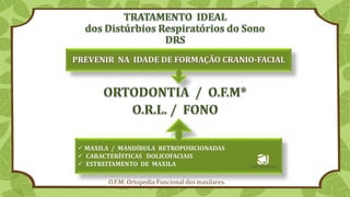 ✓ MAXILA / MANDÍBULA RETROPOSICIONADAS
✓ CARACTERÍSTICAS DOLICOFACIAIS
✓ ESTREITAMENTO DE MAXILA
O.F.M: Ortopedia Funcional dos maxilares.
 