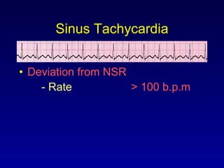 Sinus Tachycardia Deviation from NSR - Rate > 100 b.p.m 
