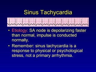 Sinus Tachycardia Etiology:  SA node is depolarizing faster than normal, impulse is conducted normally. Remember: sinus tachycardia is a response to physical or psychological stress, not a primary arrhythmia. 