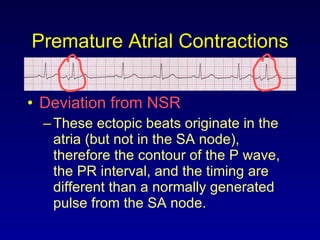 Premature Atrial Contractions Deviation from NSR These ectopic beats originate in the atria (but not in the SA node), therefore the contour of the P wave, the PR interval, and the timing are different than a normally generated pulse from the SA node. 