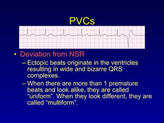 PVCs Deviation from NSR Ectopic beats originate in the ventricles resulting in wide and bizarre QRS complexes. When there are more than 1 premature beats and look alike, they are called “uniform”. When they look different, they are called “multiform”. 