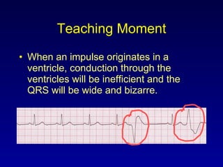 Teaching Moment When an impulse originates in a ventricle, conduction through the ventricles will be inefficient and the QRS will be wide and bizarre. 