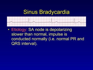 Sinus Bradycardia Etiology:  SA node is depolarizing slower than normal, impulse is conducted normally (i.e. normal PR and QRS interval). 
