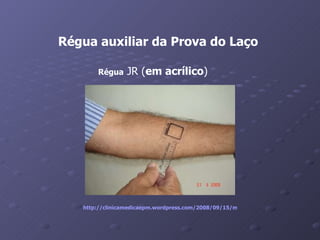 Régua auxiliar da Prova do Laço Régua  JR ( em acrílico )  http://clinicamedicaepm.wordpress.com/2008/09/15/medico-alagoano-inventa-uma-nova-ferramenta-para-o-diagnostico-da-dengue/   
