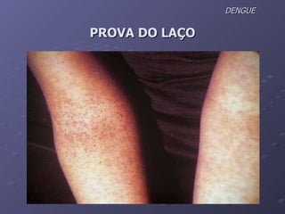 DENGUE  PROVA DO LAÇO 
