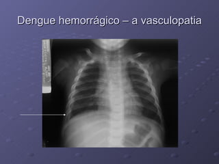 Dengue hemorrágico – a vasculopatia 
