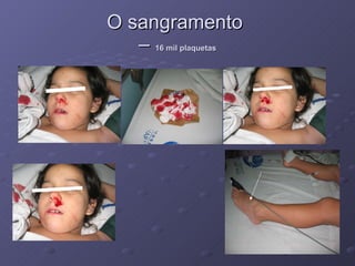 O sangramento  –  16 mil plaquetas 