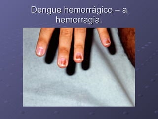 Dengue hemorrágico – a hemorragia. 