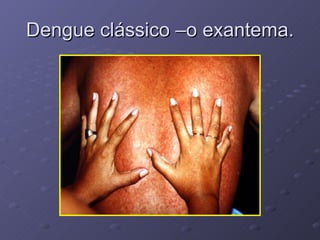 Dengue clássico –o exantema. 
