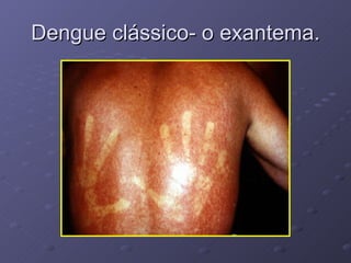Dengue clássico- o exantema. 