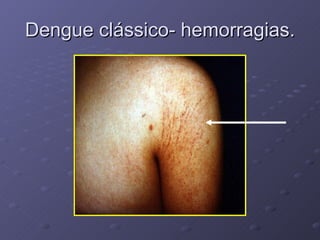 Dengue clássico- hemorragias. 