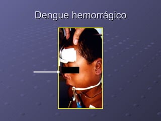 Dengue hemorrágico 