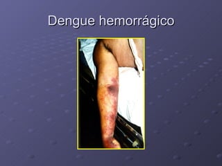 Dengue hemorrágico 