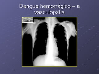 Dengue hemorrágico – a vasculopatia 