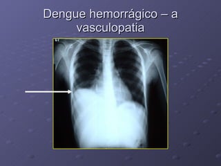 Dengue hemorrágico – a vasculopatia 