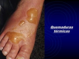 Quemaduras
 térmicas
 