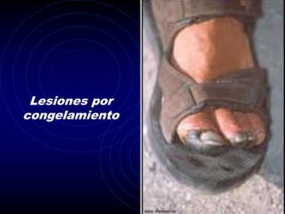 Lesiones por
congelamiento
 