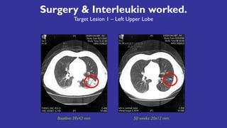 Surgery & Interleukin worked.
Target Lesion 1 – Left Upper Lobe
Baseline: 39x43 mm 50 weeks: 20x12 mm
 