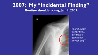 2007: My “Incidental Finding”
Routine shoulder x-ray, Jan. 2, 2007
“Your	shoulder
will	be	fine	…
but	there's	
something	
in	your	lung”
 