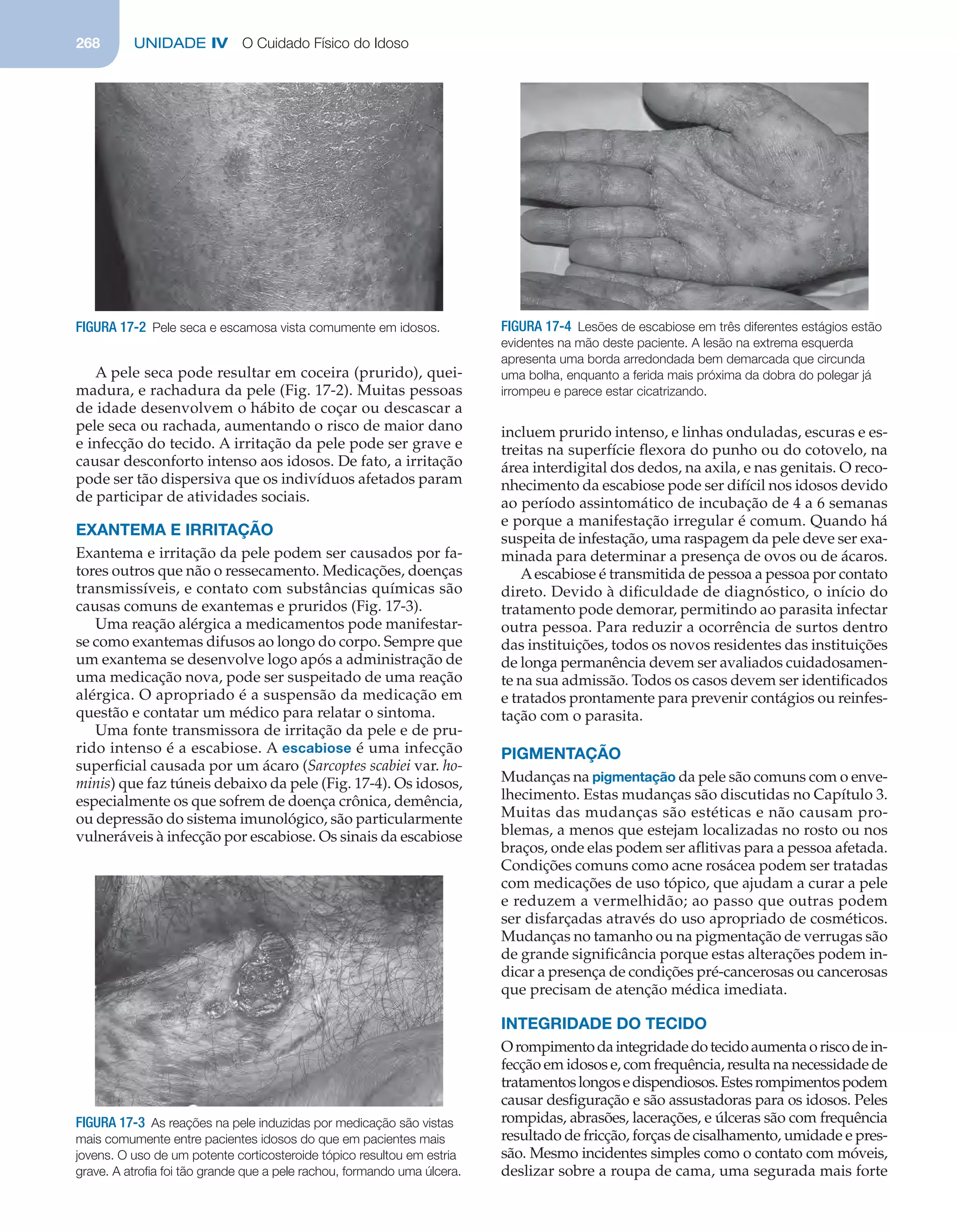 268 UNIDADE IV O Cuidado Físico do Idoso
A pele seca pode resultar em coceira (prurido), quei-
madura, e rachadura da pele (Fig. 17-2). Muitas pessoas
de idade desenvolvem o hábito de coçar ou descascar a
pele seca ou rachada, aumentando o risco de maior dano
e infecção do tecido. A irritação da pele pode ser grave e
causar desconforto intenso aos idosos. De fato, a irritação
pode ser tão dispersiva que os indivíduos afetados param
de participar de atividades sociais.
EXANTEMA E IRRITAÇÃO
Exantema e irritação da pele podem ser causados por fa-
tores outros que não o ressecamento. Medicações, doenças
transmissíveis, e contato com substâncias químicas são
causas comuns de exantemas e pruridos (Fig. 17-3).
Uma reação alérgica a medicamentos pode manifestar-
se como exantemas difusos ao longo do corpo. Sempre que
um exantema se desenvolve logo após a administração de
uma medicação nova, pode ser suspeitado de uma reação
alérgica. O apropriado é a suspensão da medicação em
questão e contatar um médico para relatar o sintoma.
Uma fonte transmissora de irritação da pele e de pru-
rido intenso é a escabiose. A escabiose é uma infecção
superﬁcial causada por um ácaro (Sarcoptes scabiei var. ho-
minis) que faz túneis debaixo da pele (Fig. 17-4). Os idosos,
especialmente os que sofrem de doença crônica, demência,
ou depressão do sistema imunológico, são particularmente
vulneráveis à infecção por escabiose. Os sinais da escabiose
incluem prurido intenso, e linhas onduladas, escuras e es-
treitas na superfície ﬂexora do punho ou do cotovelo, na
área interdigital dos dedos, na axila, e nas genitais. O reco-
nhecimento da escabiose pode ser difícil nos idosos devido
ao período assintomático de incubação de 4 a 6 semanas
e porque a manifestação irregular é comum. Quando há
suspeita de infestação, uma raspagem da pele deve ser exa-
minada para determinar a presença de ovos ou de ácaros.
Aescabiose é transmitida de pessoa a pessoa por contato
direto. Devido à diﬁculdade de diagnóstico, o início do
tratamento pode demorar, permitindo ao parasita infectar
outra pessoa. Para reduzir a ocorrência de surtos dentro
das instituições, todos os novos residentes das instituições
de longa permanência devem ser avaliados cuidadosamen-
te na sua admissão. Todos os casos devem ser identiﬁcados
e tratados prontamente para prevenir contágios ou reinfes-
tação com o parasita.
PIGMENTAÇÃO
Mudanças na pigmentação da pele são comuns com o enve-
lhecimento. Estas mudanças são discutidas no Capítulo 3.
Muitas das mudanças são estéticas e não causam pro-
blemas, a menos que estejam localizadas no rosto ou nos
braços, onde elas podem ser aﬂitivas para a pessoa afetada.
Condições comuns como acne rosácea podem ser tratadas
com medicações de uso tópico, que ajudam a curar a pele
e reduzem a vermelhidão; ao passo que outras podem
ser disfarçadas através do uso apropriado de cosméticos.
Mudanças no tamanho ou na pigmentação de verrugas são
de grande signiﬁcância porque estas alterações podem in-
dicar a presença de condições pré-cancerosas ou cancerosas
que precisam de atenção médica imediata.
INTEGRIDADE DO TECIDO
Orompimentodaintegridadedotecidoaumentaoriscodein-
fecção em idosos e, com frequência, resulta na necessidade de
tratamentoslongosedispendiosos.Estesrompimentospodem
causar desﬁguração e são assustadoras para os idosos. Peles
rompidas, abrasões, lacerações, e úlceras são com frequência
resultado de fricção, forças de cisalhamento, umidade e pres-
são. Mesmo incidentes simples como o contato com móveis,
deslizar sobre a roupa de cama, uma segurada mais forte
FIGURA 17-2 Pele seca e escamosa vista comumente em idosos.
FIGURA 17-3 As reações na pele induzidas por medicação são vistas
mais comumente entre pacientes idosos do que em pacientes mais
jovens. O uso de um potente corticosteroide tópico resultou em estria
grave. A atroﬁa foi tão grande que a pele rachou, formando uma úlcera.
FIGURA 17-4 Lesões de escabiose em três diferentes estágios estão
evidentes na mão deste paciente. A lesão na extrema esquerda
apresenta uma borda arredondada bem demarcada que circunda
uma bolha, enquanto a ferida mais próxima da dobra do polegar já
irrompeu e parece estar cicatrizando.
C0085.indd 268C0085.indd 268 11/03/13 12:31 PM11/03/13 12:31 PM
 