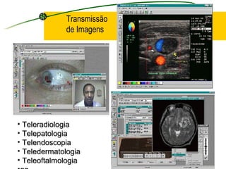 Transmissão
de Imagens
• TeleradiologiaTeleradiologia
• TelepatologiaTelepatologia
• TelendoscopiaTelendoscopia
• TeledermatologiaTeledermatologia
• TeleoftalmologiaTeleoftalmologia
 