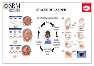 STAGES OF LABOUR
 