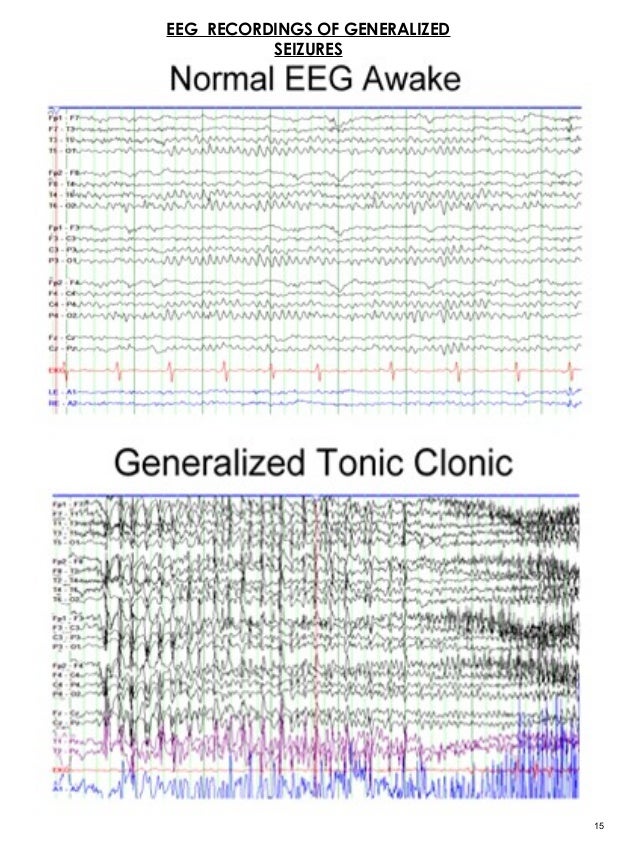 epilepsy on eeg vs normal epilepsy on eeg vs normal