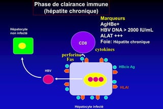 Hépatocyte infecté
HBV
CD8
Fas
perforine
Hépatocyte
non infecté
Phase de clairance immune
(hépatite chronique)
Marqueurs
AgHBe+
HBV DNA > 2000 IU/mL
ALAT +++
Foie: Hépatite chronique
HBc/e Ag
HLAI
cytokines
 