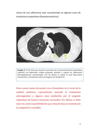 9
rotura de una adherencia muy vascularizada en algunos casos de
neumotórax espontáneo (hemoneumotórax).
Otras causas menos frecuentes son el hemotórax en el curso de la
embolia pulmonar, especialmente asociado al tratamiento
anticoagulante; y algunos casos producidos por el sangrado
espontáneo de lesiones tumorales necrosadas. Por último, se debe
tener en cuenta la posibilidad de que exista de base un trastorno de
la coagulación o vasculitis.
Imagen 5: TC de tórax que muestra la presencia de un hemoneumotórax espontáneo
izquierdo con importante colapso pulmonar asociado a ruptura de adherencias
pleuropulmonares vascularizadas. Con las flechas se señala el nivel hidro-aéreo
característico. Extraída del archivo de imágenes Dr. Rombolá CA.
 
