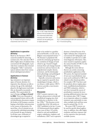 Applications in operative
dentistry
Based on the literature, CBCT
cannot be justified for detecting
occlusal caries. Not only does CBCT
deliver higher doses of radiation than
conventional 2D radiographs, it pro-
vides lower resolution than intraoral
radiographs.6
Table 1 summarizes
typical radiation doses from various
dental radiological procedures.6
Applications in forensic
dentistry
Age estimation is an important
aspect of forensic dentistry. It is
imperative that clinicians are able to
estimate the age of the individuals
placed in the legal system (and those
who are deceased) as accurately as
possible. This is particularly the
case in Europe, as Yang et al noted
in 2006: “Every year thousands of
unaccompanied minors with no offi-
cial identification documents trespass
the borders of all European countries
hoping to find shelter and protection
in the country of destination. On
top of that, a lot of criminal acts are
committed by individuals pretending
to be beneath the age of majority.
In all these cases, verification of
chronological age is required in
order to be entitled to a guardian
and social benefits, as is the case in
Belgium unaccompanied minors.”124
The literature is populated with
articles for estimating age based on
the correlation of changes of teeth
related to age. Enamel is largely
immune from such changes beyond
normal wear and tear; however, the
pulpodentinal complex (dentin,
cementum, and the dental pulp)
shows physiologic and pathological
changes with advancing age.124
Typically, extraction and section-
ing are required to quantify these
morphological changes, which is
not always a viable option. CBCT,
however, provides a non-invasive
alternative.124
Discussion
CBCT scanners represent a sig-
nificant advancement in dental and
maxillofacial imaging since their
introduction to dentistry in the
late 1990s.125
This literature review
revealed that of the 540 articles on
CBCT published in the last 12 years,
129 demonstrated clinical applica-
tions; most of these 129 articles
related to oral and maxillofacial
surgery, endodontics, implants, and
orthodontics. CBCT use in operative
dentistry is limited because of its
higher radiation dose compared to
conventional 2D radiography and
its inability to provide new or addi-
tional diagnostic information. Also,
more research is required to explore
the various benefits of CBCT in the
field of forensic dentistry.
Although this review did not
discover any articles concerning
prosthodontic applications of the
3D scanner, the improved standard
of care seen in prosthodontic treat-
ment can be attributed to CBCT use
related to other dental specialties.
For example, CBCT has been used
for prosthetic-driven implant place-
ment, maxillofacial prosthodontics,
and TMD evaluations, which in
turn have increased the success of
prosthodontic treatment by incor-
porating additional patient data into
the treatment plan. CBCT images
are an important adjunct in complex
treatment cases, particularly in cases
where multiple teeth and bony areas
must be assessed (Fig. 12–15).
The newer CBCT systems can
be used for specific dental applica-
tions; in addition, they offer higher
resolution and lower exposure and
are less expensive than previously
available systems.
Fig. 15. Clinical photograph taken after extractions of teeth
No. 7–10 and bone grafting.
Fig. 13. Periapical radiograph showing a
compromised crown-to-root ratio.
Fig. 14. CBCT image showing the
absence of the buccal plate and
the compromised palatal plate,
indicating which teeth require
extraction and site grafting prior
to implant placement.
www.agd.org General Dentistry September/October 2012 395
 