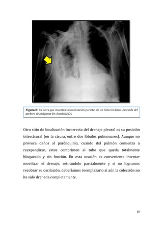 10
Otro sitio de localización incorrecta del drenaje pleural es su posición
intercisural (en la cisura, entre dos lóbulos pulmonares). Aunque no
provoca daños al parénquima, cuando del pulmón comienza a
reexpandirse, estos comprimen al tubo que queda totalmente
bloqueado y sin función. En esta ocasión es conveniente intentar
movilizar el drenaje, retirándolo parcialmente y si no logramos
recobrar su oscilación, deberíamos reemplazarlo si aún la colección no
ha sido drenada completamente.
Figura 8: Rx de tx que muestra la localización parietal de un tubo torácico. Extraída del
archivo de imágenes Dr. Rombolá CA.
 