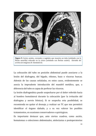 11
La colocación del tubo en posición abdominal puede asociarse a la
lesión del diafragma, del hígado, riñones, bazo o vísceras huecas.
Además de las causas señaladas, en estos casos, evidentemente se
asocia la imprudente introducción del mandril metálico, que, a
diferencia del tubo es capaz de perforar las vísceras.
La lesión diafragmática puede sospecharse por el dolor referido hacia
al hombro homolateral durante la colocación (por la irritación del
diafragma y nervio frénico). Si se sospecha esta posibilidad, se
recomienda no quitar el drenaje, y realizar un TC que nos permitirá
identificar el órgano dañado, y a su vez valorar los posibles
tratamientos, en ocasiones conservadores o quirúrgicos.
Es importante destacar que, ante ciertos cuadros, como ascitis,
hematomas o colecciones abdominales, atelectasias o postoperatorios
Figura 9: Cortes axiales, coronales y sagitales que muestra un tubo (señalado con la
flecha amarilla) colocado en la cisura (señalada con flechas azules). Extraída del
archivo de imágenes Dr. Rombolá CA.
 