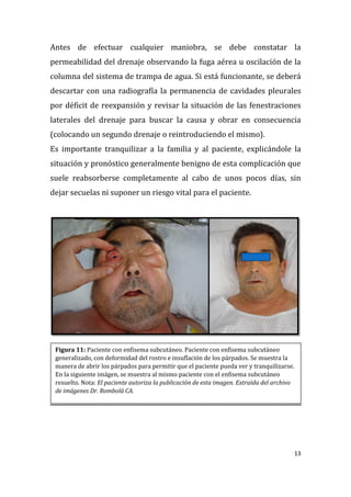 13
Antes de efectuar cualquier maniobra, se debe constatar la
permeabilidad del drenaje observando la fuga aérea u oscilación de la
columna del sistema de trampa de agua. Si está funcionante, se deberá
descartar con una radiografía la permanencia de cavidades pleurales
por déficit de reexpansión y revisar la situación de las fenestraciones
laterales del drenaje para buscar la causa y obrar en consecuencia
(colocando un segundo drenaje o reintroduciendo el mismo).
Es importante tranquilizar a la familia y al paciente, explicándole la
situación y pronóstico generalmente benigno de esta complicación que
suele reabsorberse completamente al cabo de unos pocos días, sin
dejar secuelas ni suponer un riesgo vital para el paciente.
Figura 11: Paciente con enfisema subcutáneo. Paciente con enfisema subcutáneo
generalizado, con deformidad del rostro e insuflación de los párpados. Se muestra la
manera de abrir los párpados para permitir que el paciente pueda ver y tranquilizarse.
En la siguiente imágen, se muestra al mismo paciente con el enfisema subcutáneo
resuelto. Nota: El paciente autoriza la publicación de esta imagen. Extraída del archivo
de imágenes Dr. Rombolá CA.
 