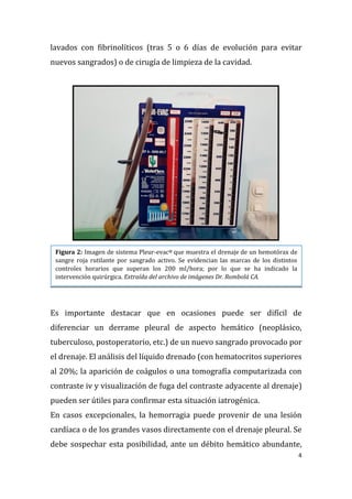 4
lavados con fibrinolíticos (tras 5 o 6 días de evolución para evitar
nuevos sangrados) o de cirugía de limpieza de la cavidad.
Es importante destacar que en ocasiones puede ser difícil de
diferenciar un derrame pleural de aspecto hemático (neoplásico,
tuberculoso, postoperatorio, etc.) de un nuevo sangrado provocado por
el drenaje. El análisis del líquido drenado (con hematocritos superiores
al 20%; la aparición de coágulos o una tomografía computarizada con
contraste iv y visualización de fuga del contraste adyacente al drenaje)
pueden ser útiles para confirmar esta situación iatrogénica.
En casos excepcionales, la hemorragia puede provenir de una lesión
cardíaca o de los grandes vasos directamente con el drenaje pleural. Se
debe sospechar esta posibilidad, ante un débito hemático abundante,
Figura 2: Imagen de sistema Pleur-evac® que muestra el drenaje de un hemotórax de
sangre roja rutilante por sangrado activo. Se evidencian las marcas de los distintos
controles horarios que superan los 200 ml/hora; por lo que se ha indicado la
intervención quirúrgica. Extraída del archivo de imágenes Dr. Rombolá CA.
 