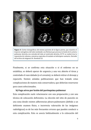 6
Finalmente, si se confirma esta situación o si el enfermo no se
estabiliza, se deberá operar de urgencia y una vez abierto el tórax y
controlado el vaso dañado (o el corazón); se deberá retirar el drenaje y
repararlo. Existen aisladas publicaciones que han tratado estas
complicaciones de manera más conservadora, que deberían reservarse
para casos seleccionados.
b) Fuga aérea por lesión del parénquima pulmonar
Esta complicación suele relacionarse con una preparación y con una
técnica de colocación deficientes. La elección del sitio de punción en
una zona donde existen adherencias pleuro-pulmonares (debido a un
deficiente examen físico, e incorrecta valoración de las imágenes
radiológicas) es de los más frecuentes errores que pueden conducir a
esta complicación. Esto se asocia habitualmente a la colocación del
Figura 4: Cortes tomográficos del mismo paciente de la figura previa, que muestra el
trayecto iatrogénico del tubo (señalado con flechas) que provoca la lesión de la arteria
pulmonar derecha con entrada del tubo al ventrículo derecho. El TC se realizó tras la
reposición de volemia y mientras esperaba el traslado en helicópeto sanitario. Extraída
del archivo de imágenes Dr. Rombolá CA.
 