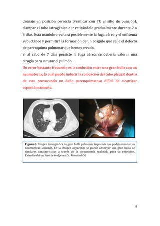 8
drenaje en posición correcta (verificar con TC el sitio de punción),
clampar el tubo iatrogénico e ir retirándolo gradualmente durante 2 o
3 días. Esta maniobra evitará posiblemente la fuga aérea y el enfisema
subuctáneo y permitirá la formación de un coágulo que selle el defecto
de parénquima pulmonar que hemos creado.
Si al cabo de 7 días persiste la fuga aérea, se debería valorar una
cirugía para suturar el pulmón.
Un error bastante frecuente es la confusión entre una gran bulla con un
neumotórax, lo cual puede inducir la colocación del tubo pleural dentro
de esta provocando un daño parenquimatoso difícil de cicatrizar
espontáneamente.
Figura 6: Imagen tomográfica de gran bulla pulmonar izquierda que podría simular un
neumotórax loculado. En la imagen adyacente se puede observar una gran bulla de
similares características a través de la toracotomía realizada para su resección.
Extraída del archivo de imágenes Dr. Rombolá CA.
 