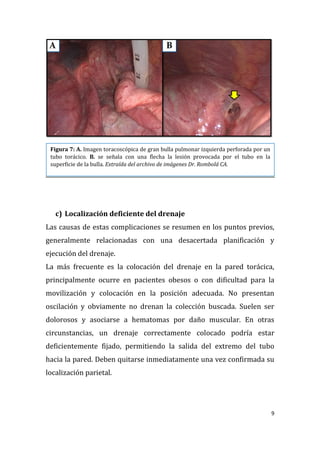 9
c) Localización deficiente del drenaje
Las causas de estas complicaciones se resumen en los puntos previos,
generalmente relacionadas con una desacertada planificación y
ejecución del drenaje.
La más frecuente es la colocación del drenaje en la pared torácica,
principalmente ocurre en pacientes obesos o con dificultad para la
movilización y colocación en la posición adecuada. No presentan
oscilación y obviamente no drenan la colección buscada. Suelen ser
dolorosos y asociarse a hematomas por daño muscular. En otras
circunstancias, un drenaje correctamente colocado podría estar
deficientemente fijado, permitiendo la salida del extremo del tubo
hacia la pared. Deben quitarse inmediatamente una vez confirmada su
localización parietal.
Figura 7: A. Imagen toracoscópica de gran bulla pulmonar izquierda perforada por un
tubo torácico. B. se señala con una flecha la lesión provocada por el tubo en la
superficie de la bulla. Extraída del archivo de imágenes Dr. Rombolá CA.
 