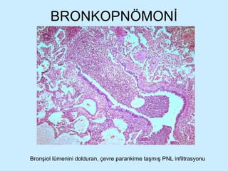 BRONKOPNÖMONİ Bronşiol lümenini dolduran, çevre parankime taşmış PNL infiltrasyonu 