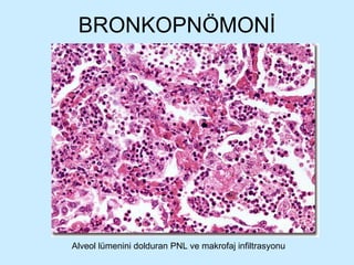 BRONKOPNÖMONİ Alveol lümenini dolduran PNL ve makrofaj infiltrasyonu 