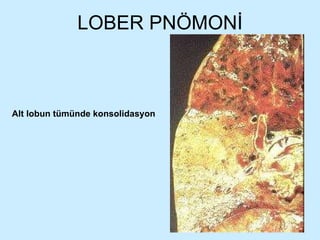 LOBER PNÖMONİ Alt lobun tümünde konsolidasyon 