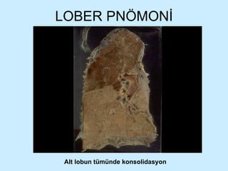 LOBER PNÖMONİ Alt lobun tümünde konsolidasyon 