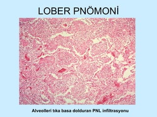 LOBER PNÖMONİ Alveolleri tıka basa dolduran PNL infiltrasyonu 