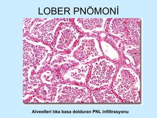 LOBER PNÖMONİ Alveolleri tıka basa dolduran PNL infiltrasyonu 