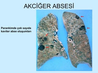 AKCİĞER ABSESİ Parankimde çok sayıda kaviter abse oluşumları 