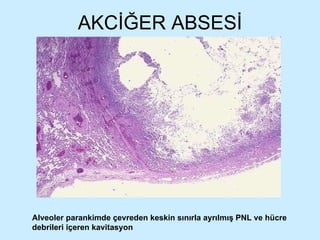 AKCİĞER ABSESİ Alveoler parankimde çevreden keskin sınırla ayrılmış PNL ve hücre debrileri içeren kavitasyon 